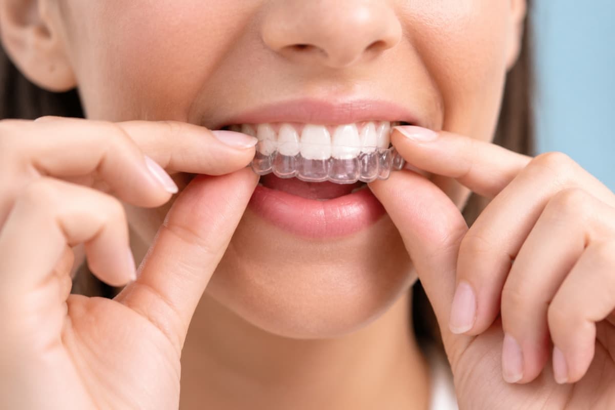 Patient fitting a clear aligner tray during orthodontic treatment planning
